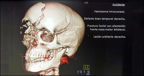 3D scan of her skull following the accident.